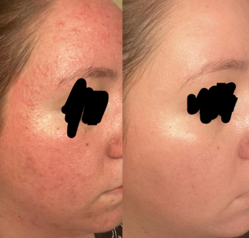 Dark Spot Eraser Serum